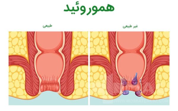 پکیج هموروئید